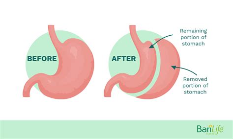 Gastric Sleeve vs. Gastric Bypass: What are the Pros and Cons?