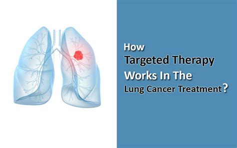 How Targeted Therapy Works In The Lung Cancer Treatment? - HBG Medical ...