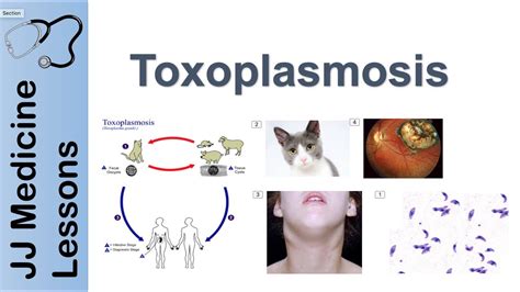 Toxoplasmosis