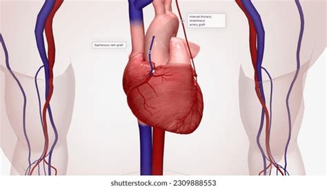 Thoracic Artery Graft: Over 62 Royalty-Free Licensable Stock ...