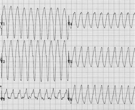 Ventricular Tachycardia – Monomorphic VT • LITFL • ECG Library