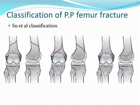 Periprosthetic Fracture Classification