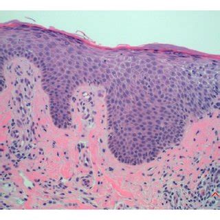 (PDF) Oxidative Stress in Atopic Dermatitis