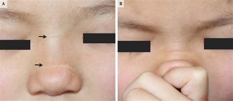 Case Study: Transverse Nasal Creases