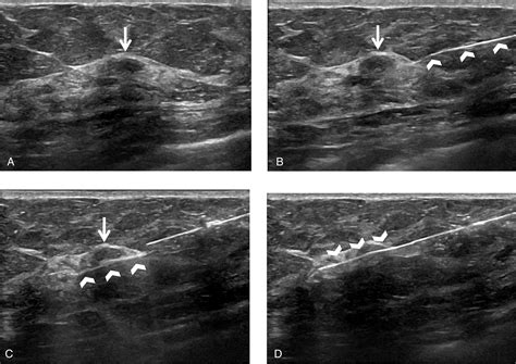 Ultrasound‐Guided Breast Biopsies - Bhatt - 2021 - Journal of Ultrasound in Medicine - Wiley ...