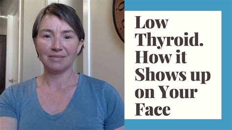 How Low Thyroid (Hypothyroid) Shows up on Your Face - YouTube