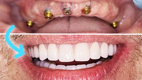 PERMANENT FIXED IMPLANT DENTURE Procedure Steps! Before & After w ...