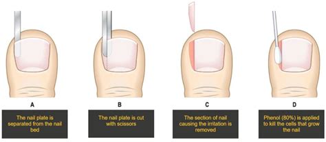 Ingrown nail treatment and surgery PNA | South West Podiatry