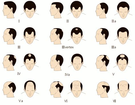 Receding Hairline: How To Deal With It The Right Way