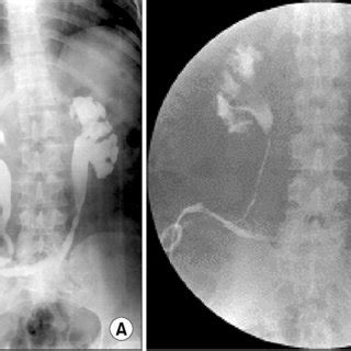 Ureterostomy Stent