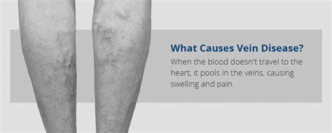 History of Vein Therapy: Past and Present - jmgunshows