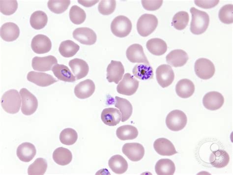 Plasmodium falciparum infection - 3.