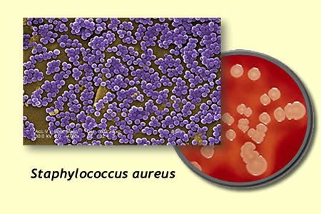 Samaritan Infectious Disease - Staphylococcus aureus Bacteremia