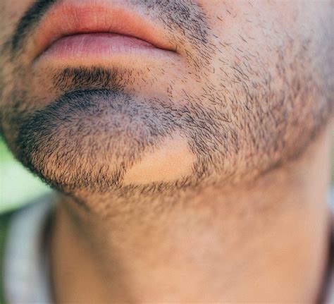 Bald patch in beard: Causes and treatments