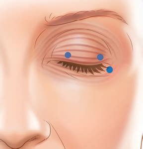 Blepharospasm | Pacific Movement Disorders