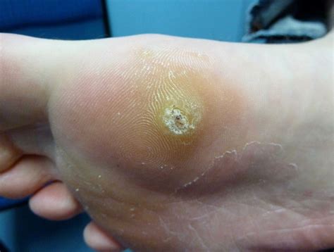 Plantar Warts Symptoms, Causes, Diagnosis and Treatment - Natural Health News