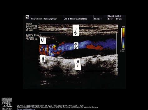 Comparison of color-flow Doppler scanning, power Doppler scanning, and ...