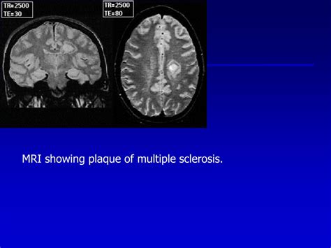 PPT - MRI showing plaque of multiple sclerosis. PowerPoint Presentation - ID:5490821