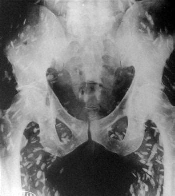 Tapeworms In Humans Xray