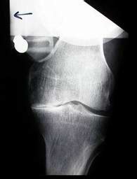 Stress Views of X-rays of Knee injuries