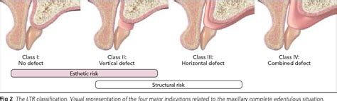 Edentulous alveolar ridge classification - ebaykera