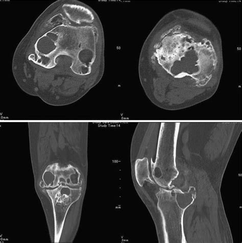 Multiple huge subchondral cysts associated with pseudogout in the bilateral knees: a case report ...