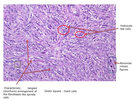 Histiocytoma, Malignant Fibrous; Malignant Fibrous Histiocytoma