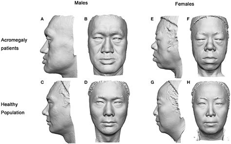 Acromegaly Models