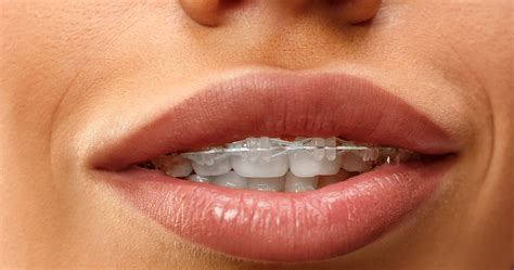 Overbite & Underbite Treatment Las Vegas - Nevada Dentistry & Braces