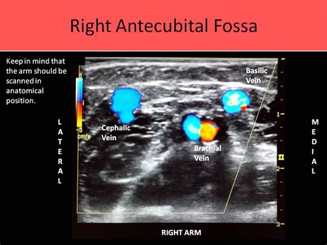 Upper Extremity Venous Anatomy | Vascular ultrasound, Ultrasound ...