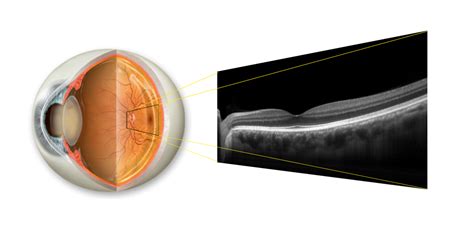 9_revb_retinal_b-scan | Black Diamond Eye Care