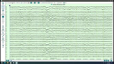 Trending intracranial seizures with P14Rev.D(x) - YouTube