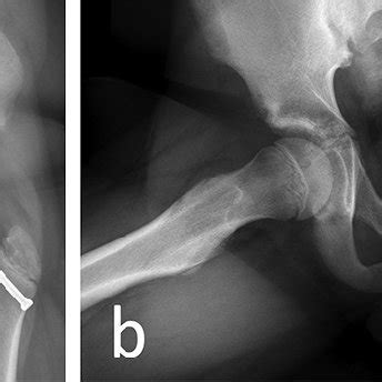 Radiological result of an 11-year-old boy treated for unstable SCFE of ...