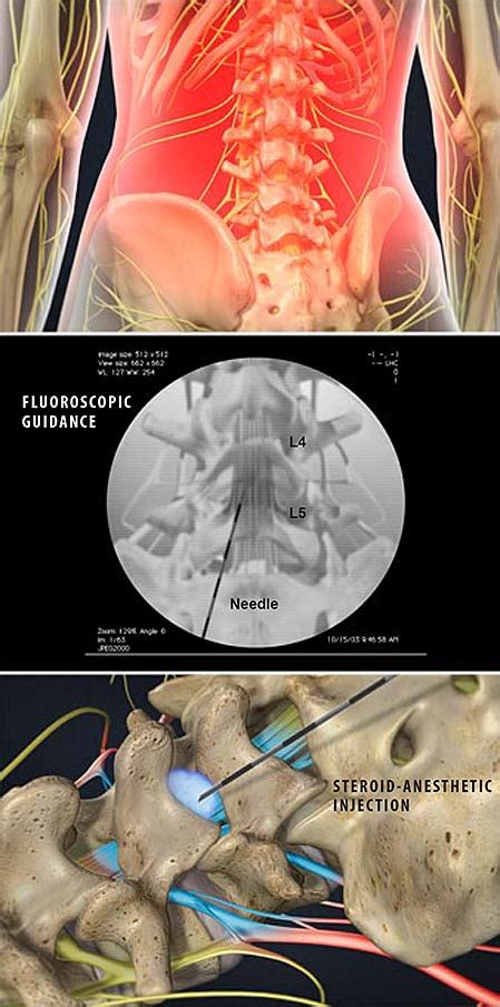 Lumbar Epidural Injection