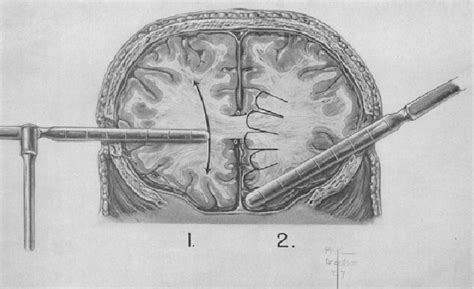 Figure 1 from A portrait of prefrontal lobotomy performed at the Royal Prince Alfred Hospital in ...