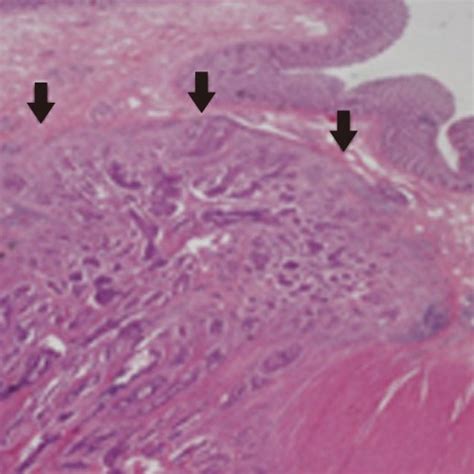 Colonoscopy revealed a submucosal, 2-cm-diameter, tumor-like lesion in... | Download Scientific ...