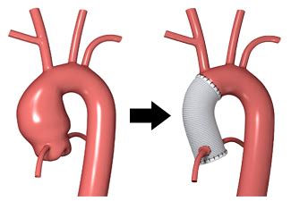 Aortic Care | Jefferson Health