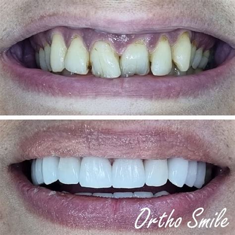 Hollywood Smile Before After | Orthosmile Clinic