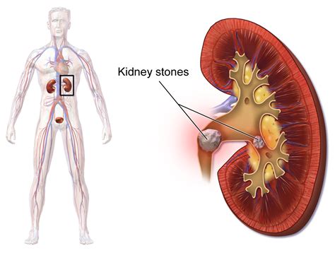 File:Blausen 0595 KidneyStones.png - Wikimedia Commons