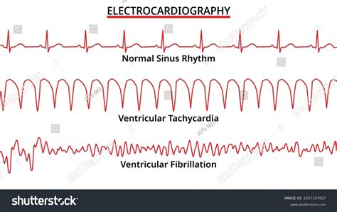 263 Abnormal Sinus Rhythm Images, Stock Photos & Vectors | Shutterstock