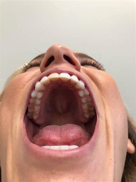 Virtual Smile Assessment for Braces | Hulse Orthodontics | Carlsbad, CA