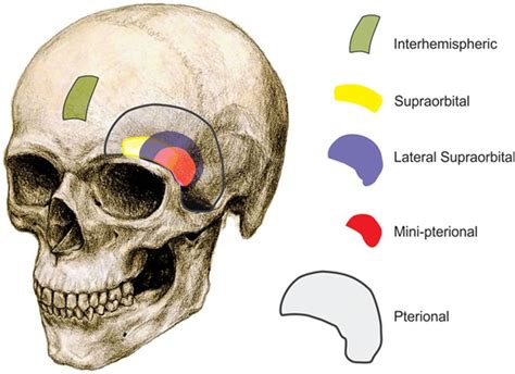 Minimally Invasive Microsurgery for Cerebral Aneurysms | Stroke