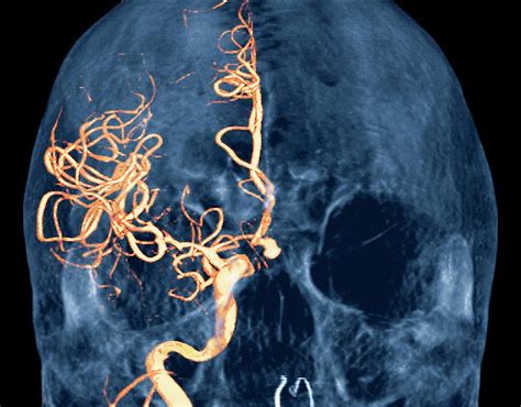 Carotid Aneurysm Photograph by Zephyr/science Photo Library - Pixels