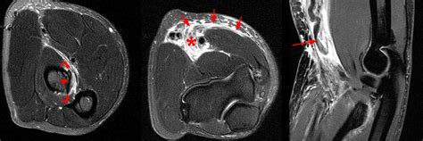 Distal Biceps Tendon Rupture Elbow - Radsource