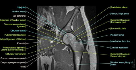 MRI Of The Iliopsoas Bursitis And Its Pitfalls, 53% OFF