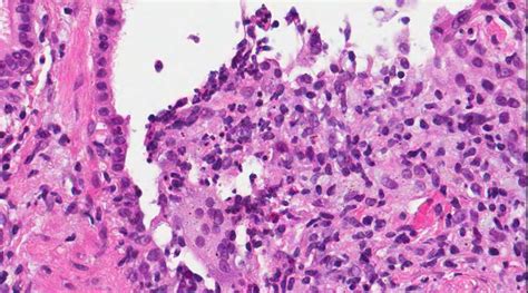 Pathology Outlines - Lipoid pneumonia