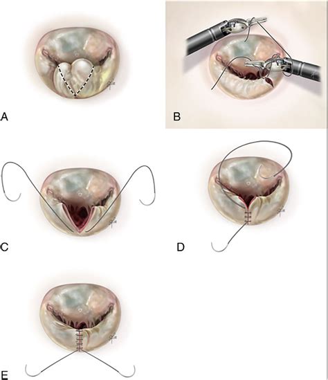 -Mitral valve repair techniques. A: triangular resection of the... | Download Scientific Diagram