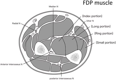 Anatomic transverse section of the forearm muscles. The FDP muscle, the ...