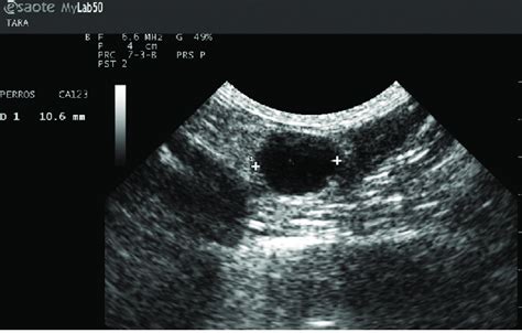 Ultrasonography showing one of the anechoic structures in the right ovary | Download Scientific ...