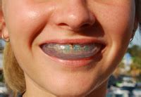 4 Must-Know Guidelines For Purchasing A Proper Braces Mouthguard